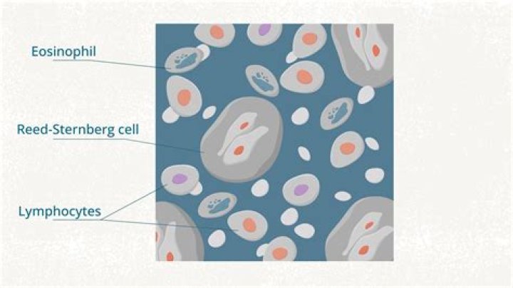 Is Stage 4 lymphoma a terminal?