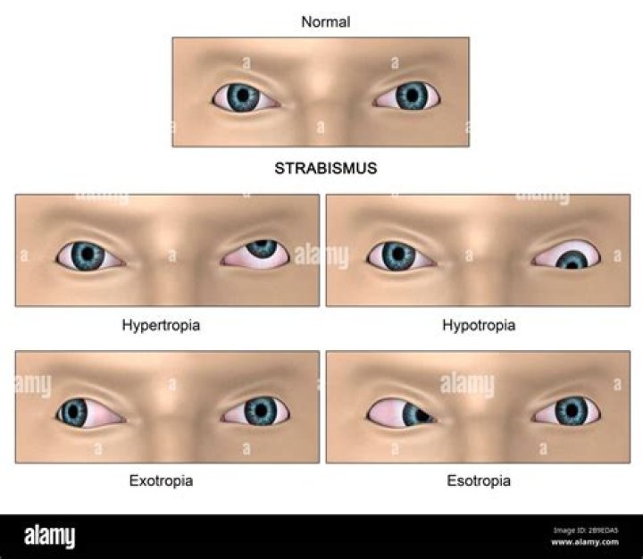 Is strabismus a neurological disorder?