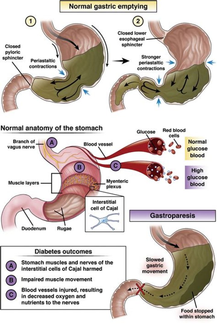 Is there a surgery for gastroparesis?
