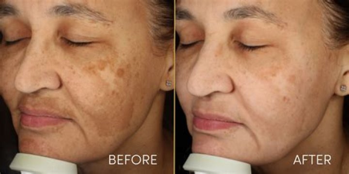 Is there any cream for pigmentation?