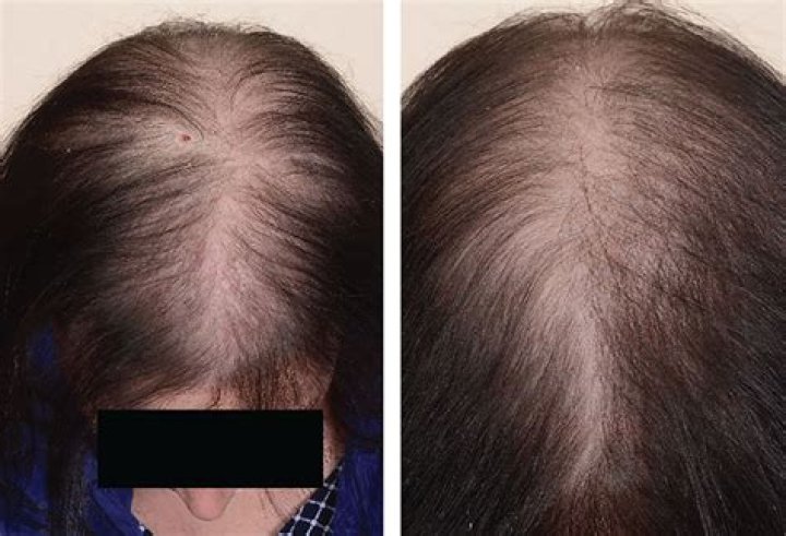 Is thinning hair genetic?