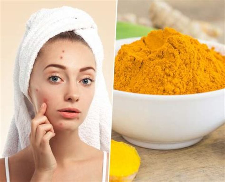Is turmeric good for pimples?