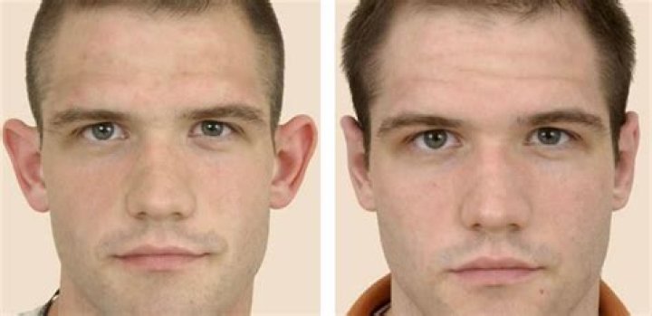 What age can ears be pinned back?