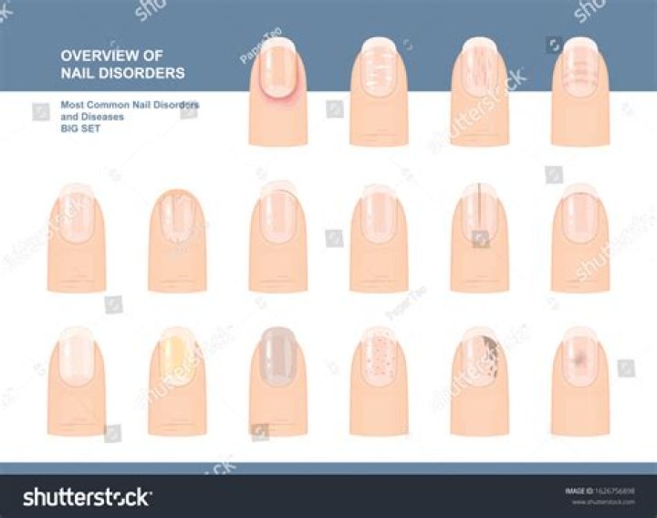 What are 8 common nail disorders?