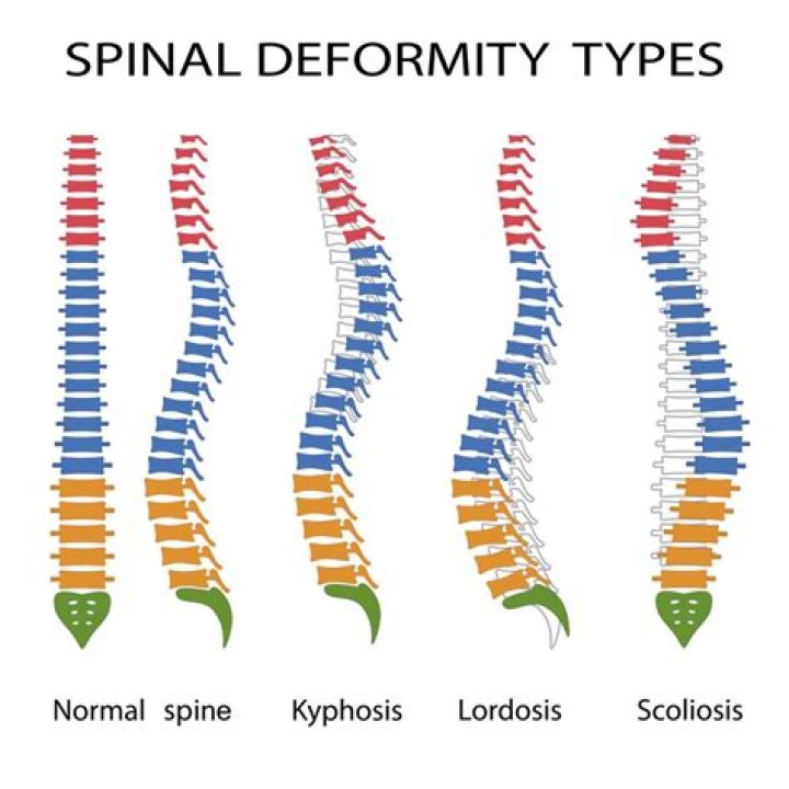 What are the three common vertebral deformities?