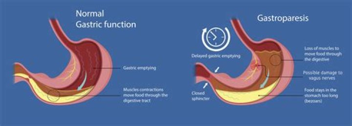 What causes gastric paralysis?