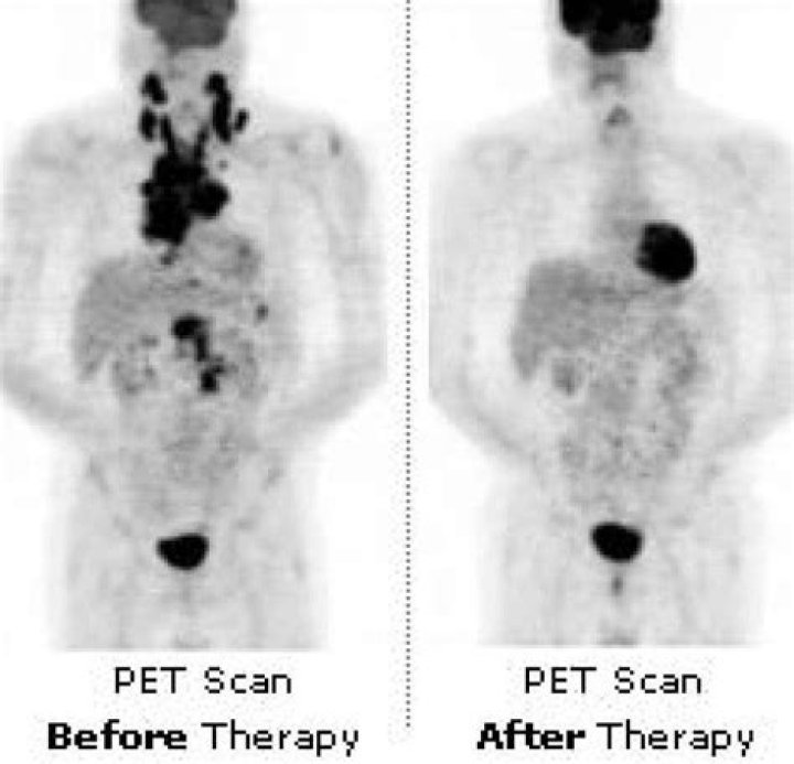 What causes hot spots on PET scans?