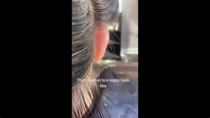 What color are dead nits?