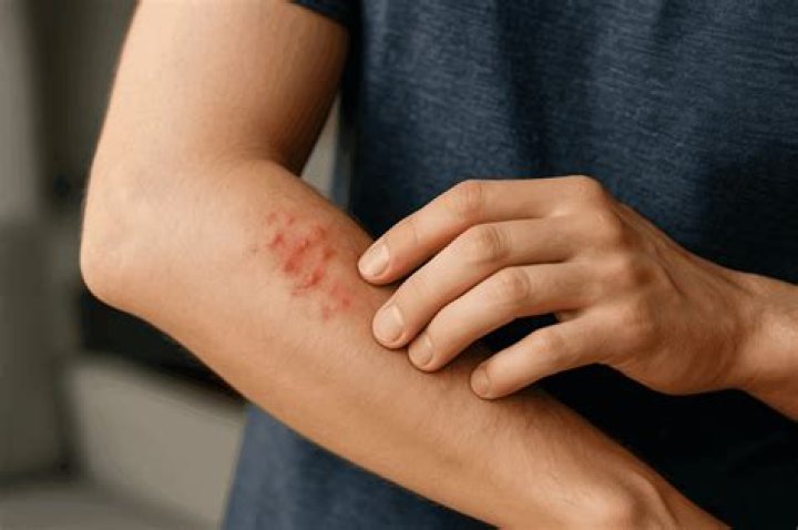 What do mite bites look like on a human?