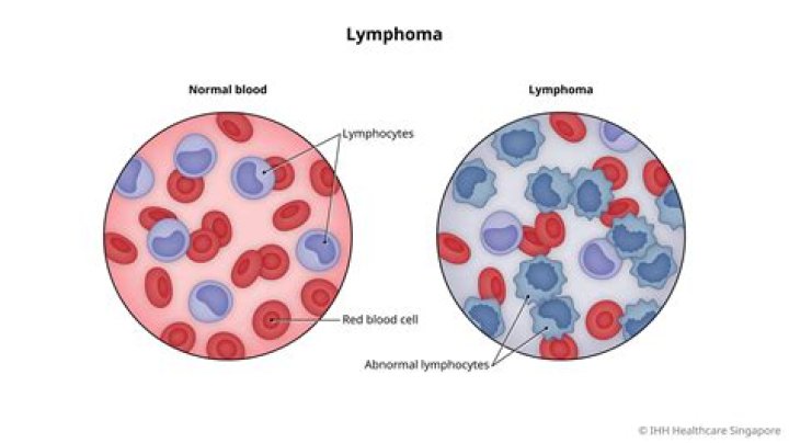 What does blood work look like with lymphoma?