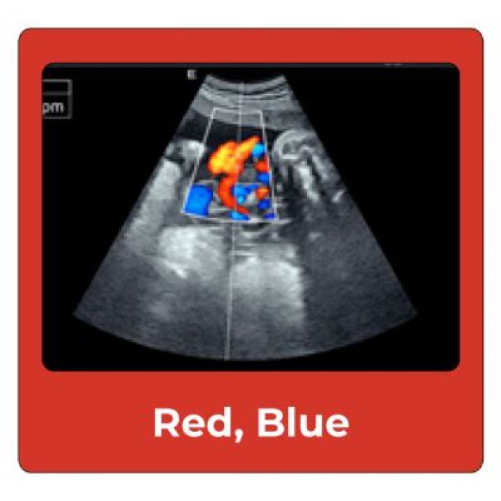 What does red mean on an ultrasound?