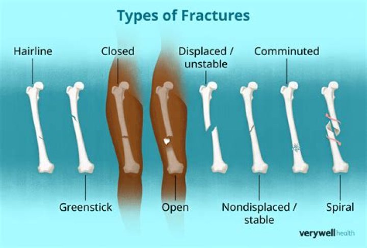 What happens in a fracture?