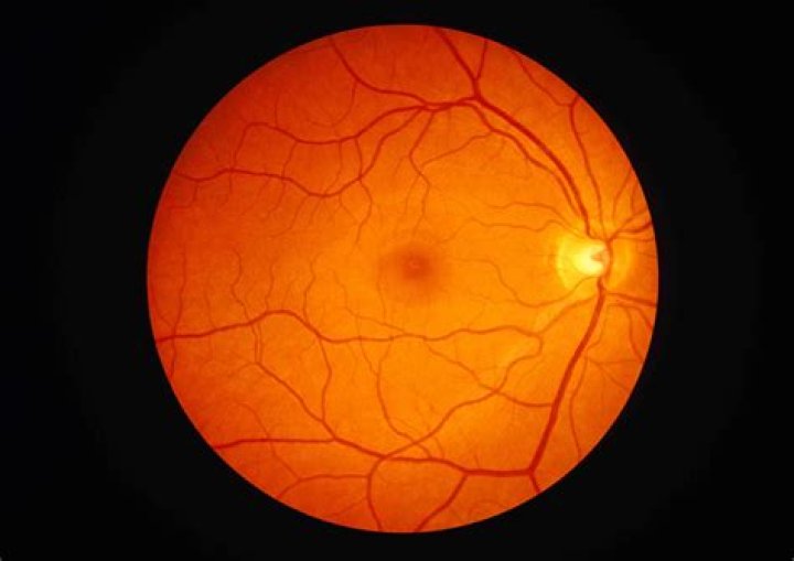What is a retinal eye photo?