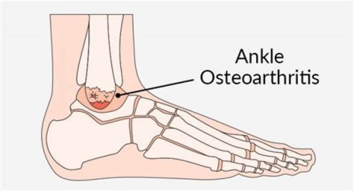 What is ankle osteoarthritis?