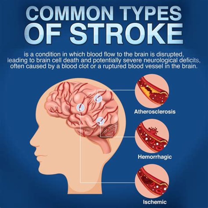 What is considered a severe stroke?
