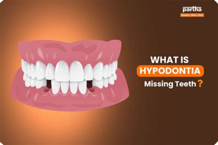 What is dental hypodontia?