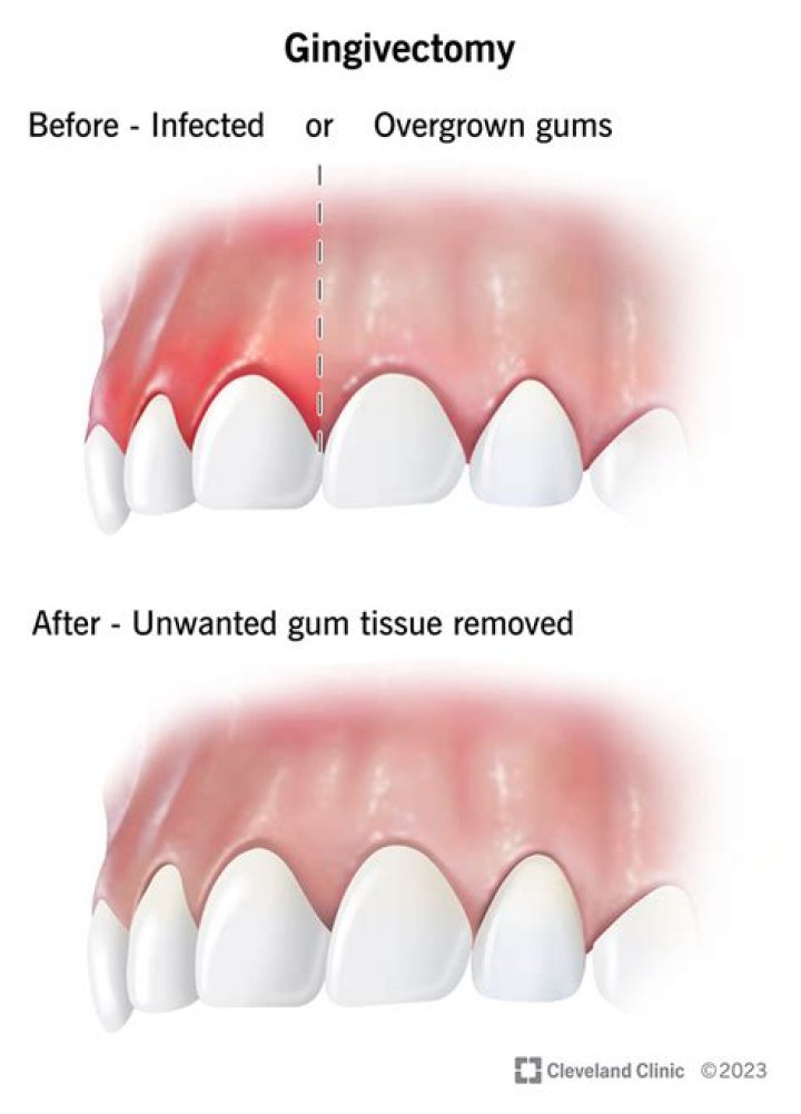 What is it called when gums grow over teeth?