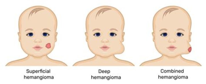 What is oral hemangioma?