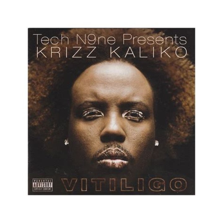 What is wrong with Krizz Kaliko eyes?