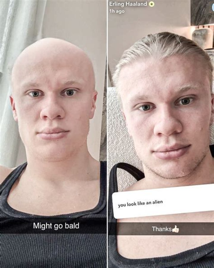 What race gets bald most?