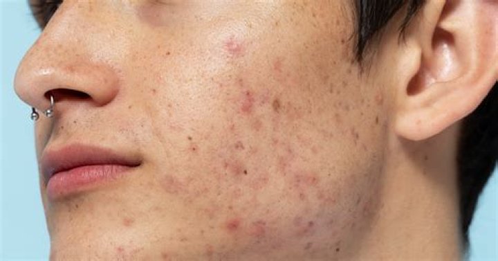 What race is prone acne?