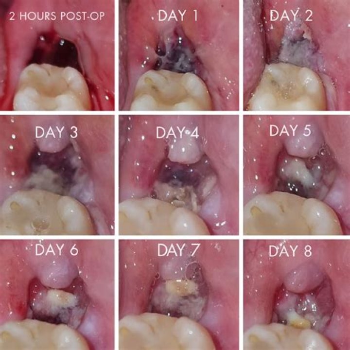 What should a tooth extraction look like after 7 days?
