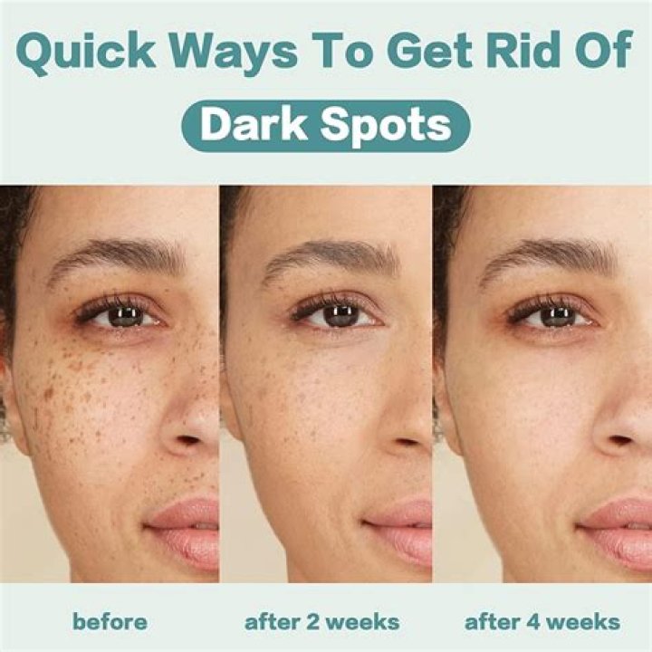 What should we eat to remove dark spots on face?
