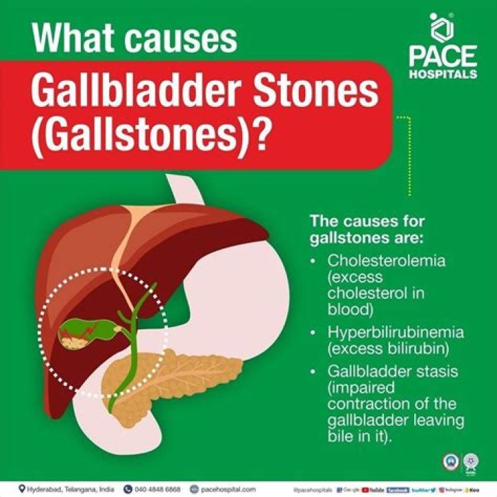 What size gallstones can you pass?