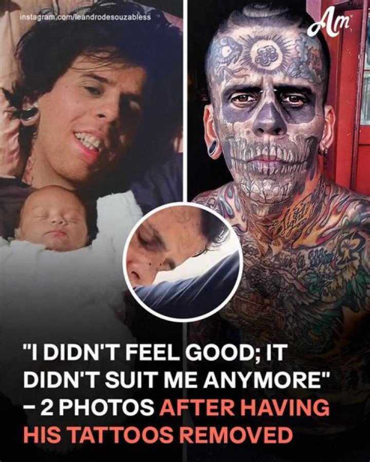 What star is having tattoos removed?