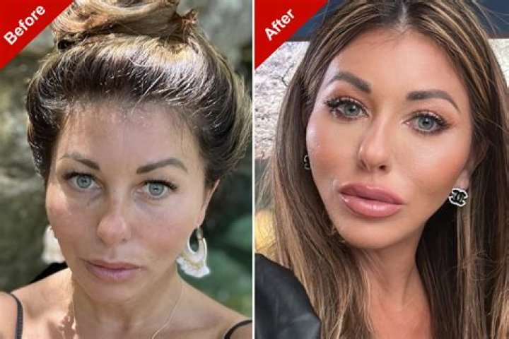 What surgery has Stassiebaby had?