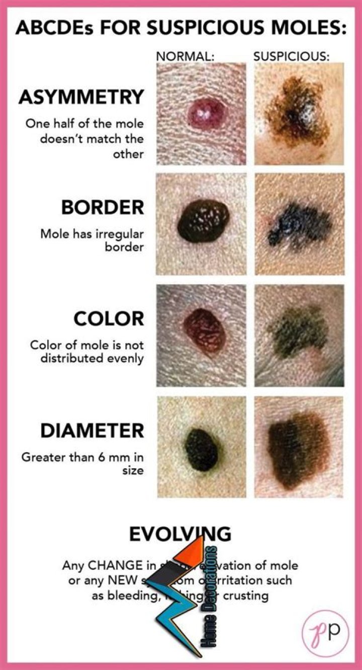 When is a mole suspicious?