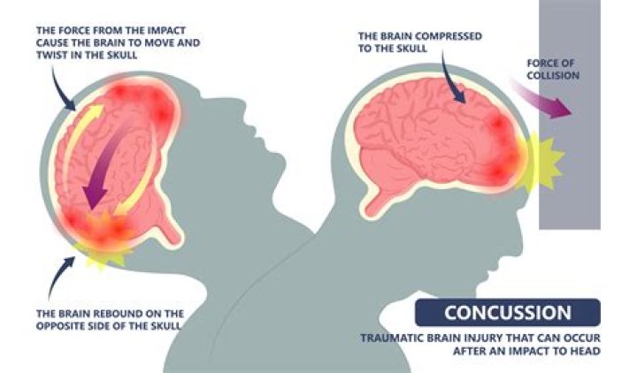 Which NFL position has most concussions?