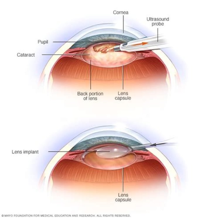 Which type of cataract surgery is best?