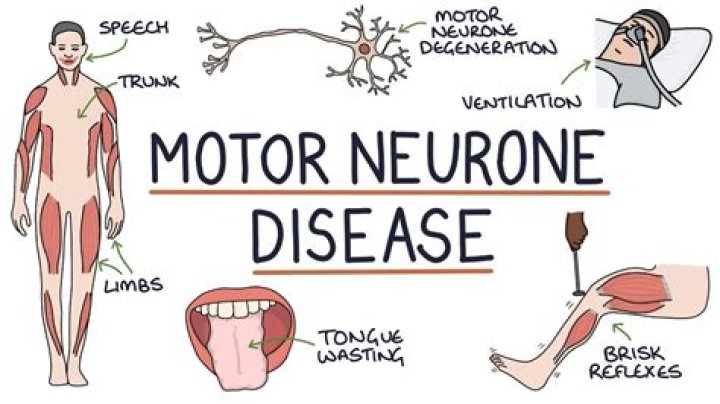 Who has motor neuron disease in The Split?