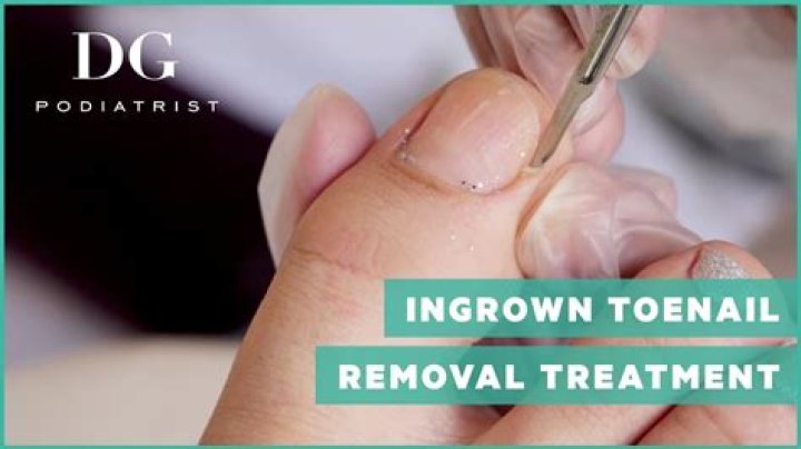 WHO removes ingrown toenails?