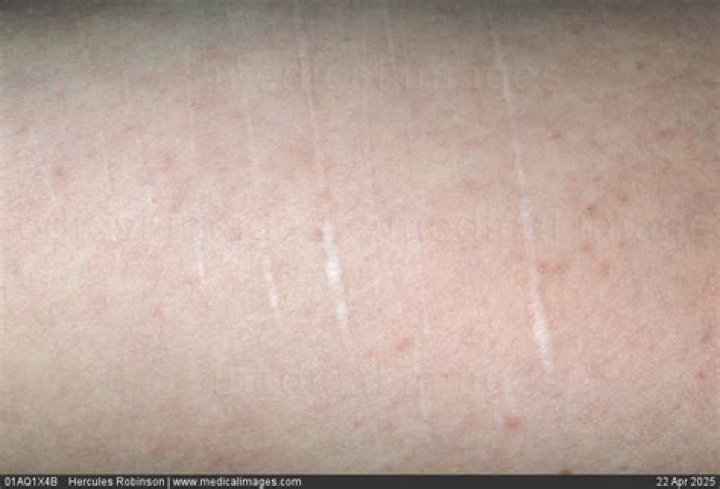 Why are my scars white?
