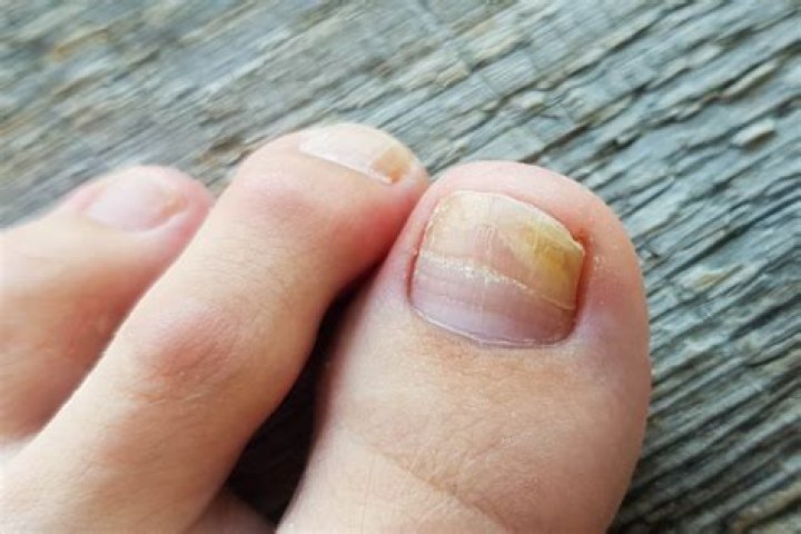 Why are my toenails not clear?