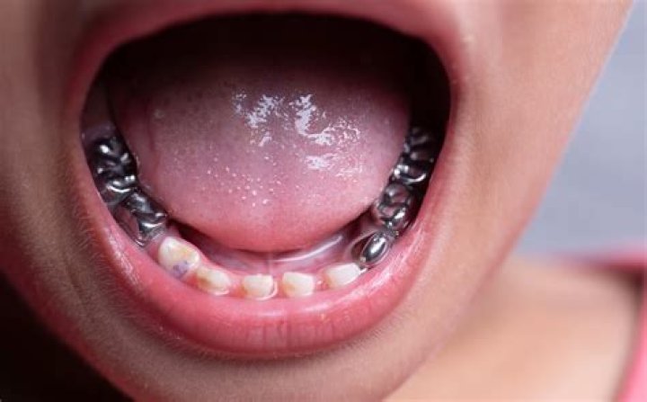 Why can't kids get white crowns?
