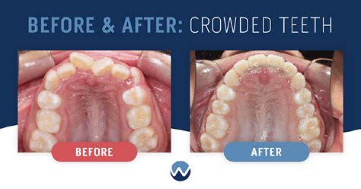 Why do bottom teeth get crooked with age?