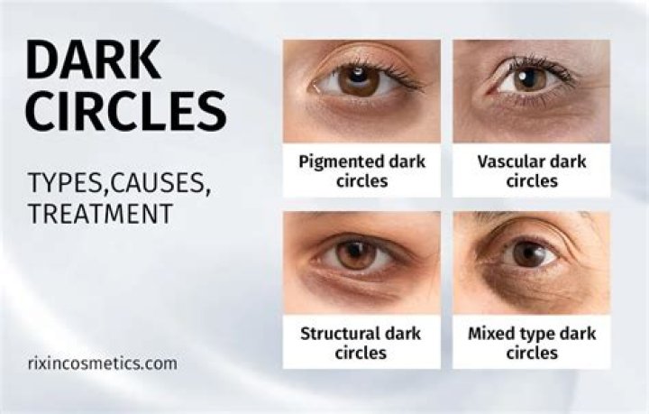Why do I have dark circles at 13?