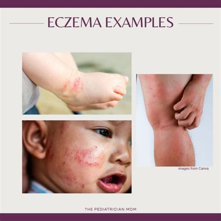 Why does eczema come back in same spot?