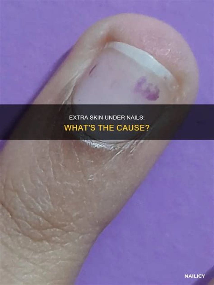 Why does extra skin grow under my nails?