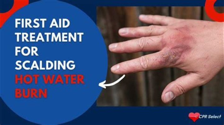 Why does hot water help burns?