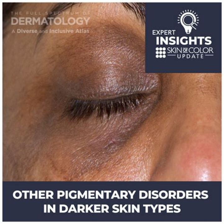Why is my skin complexion getting darker?