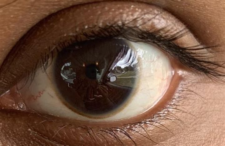 Why is there a GREY ring around my iris?