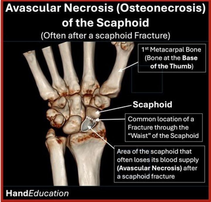 Will a bone scan show avascular necrosis?