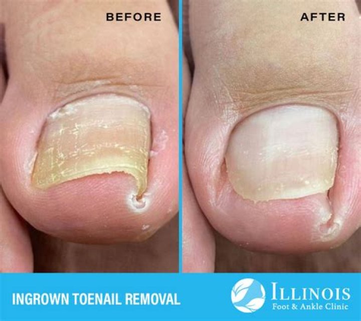 Will I need time off work after toenail removal?